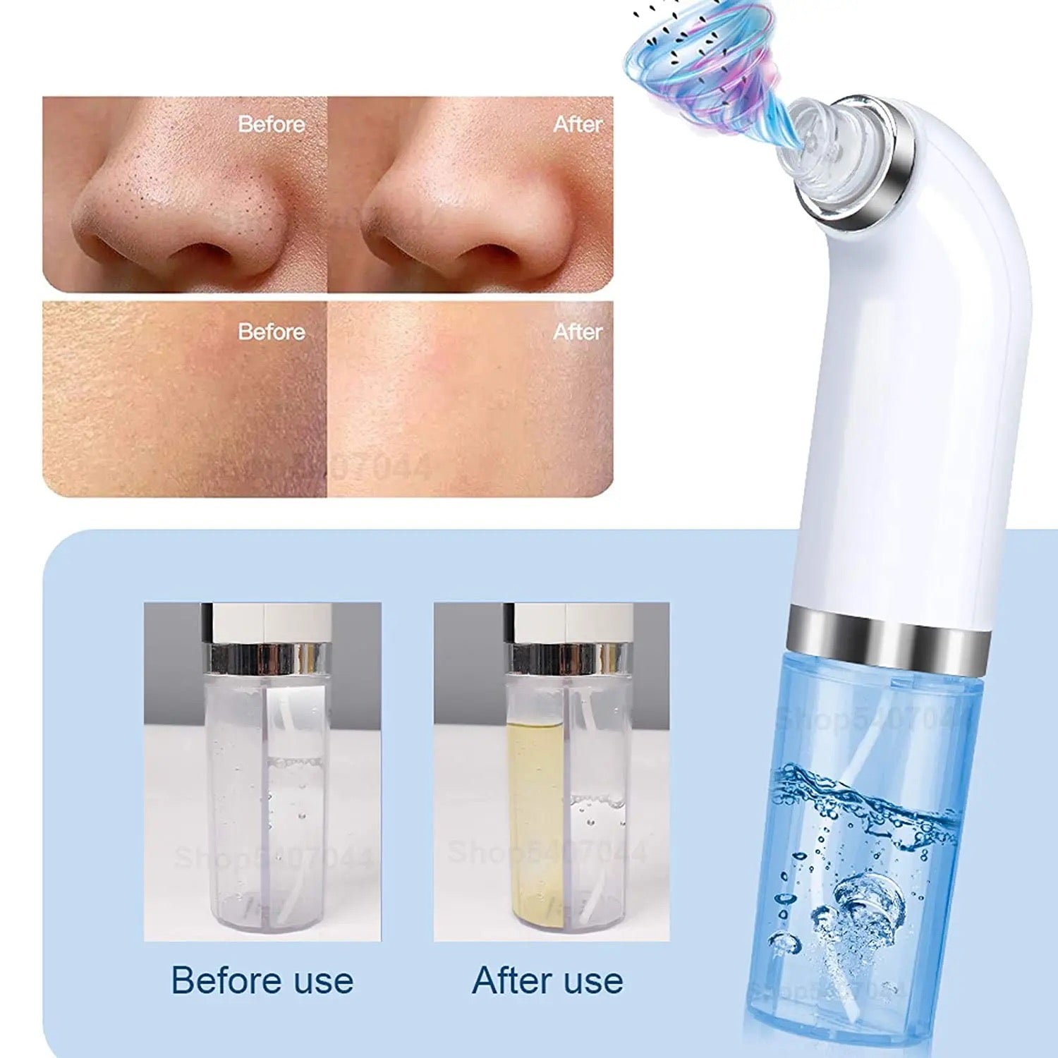 Vacuum Blackhead / Whitehead Remover